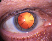 Cataract
