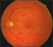 Diabetic Retinopathy