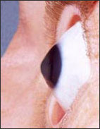 Keratoconus disorder