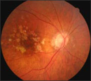 Macular Degeneration